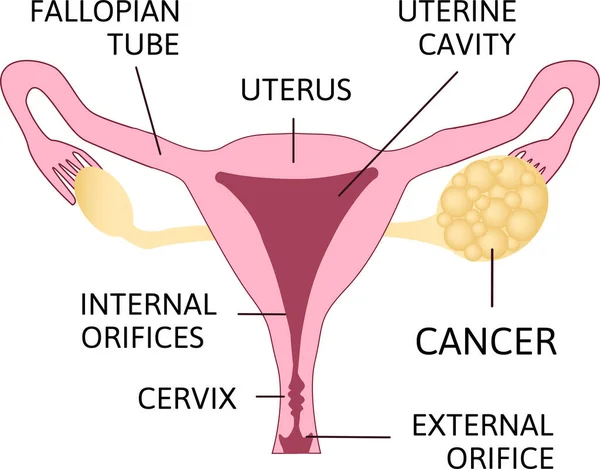 Cáncer Ovario Carcinoma Ovario Tumor Células Germinativas Tumor Del Estroma — Vector de stock