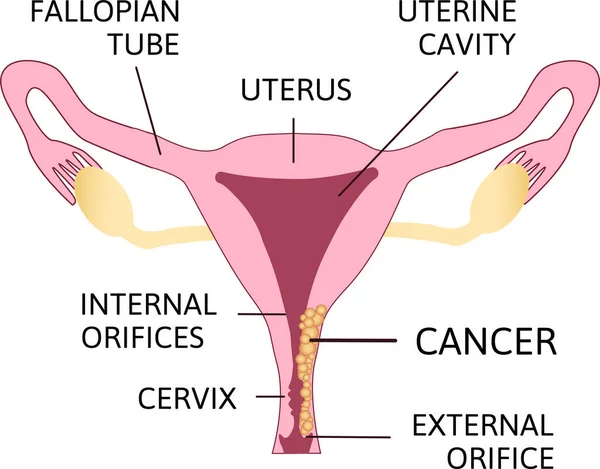 자궁경부암 자궁경부암이야 자궁경부에 세포에서 일어나는 신생물이야 종양학 해부학적 — 스톡 벡터