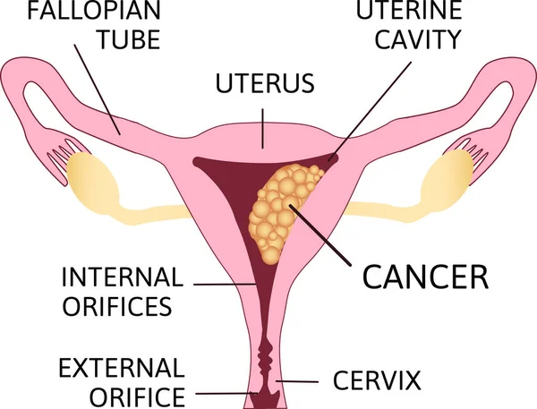 Uterine Cancer Vector Poster Chart Met Kankercellen Endometrium Tissue Van — Stockvector