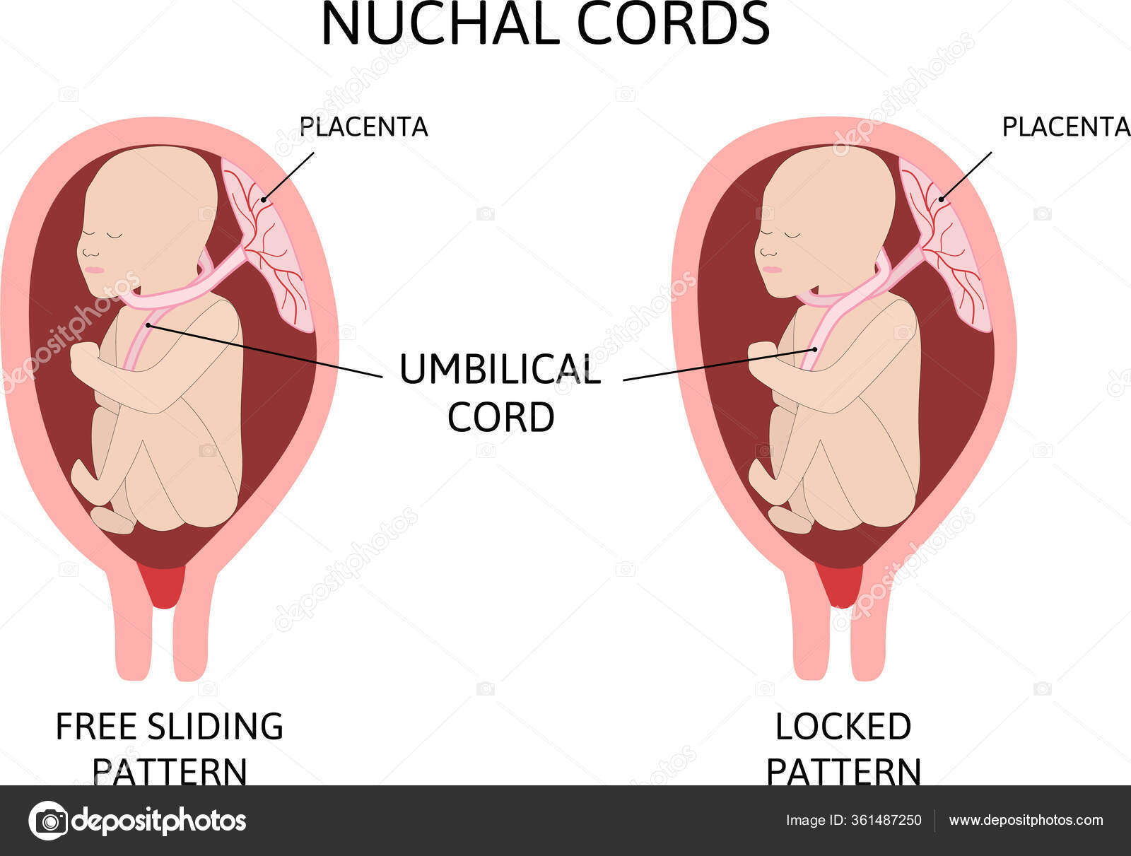 Cordon Umbilical Alrededor Del Cuello Cordon Nucal Dos Lazos Estan Vector Grafico Vectorial C Betty1994 Imagen Cordon Umbilical Alrededor Del Cuello Cordon Nucal Dos Lazos Estan Vector Grafico Vectorial C Betty1994 Imagen