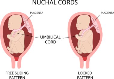 Boynun etrafındaki göbek kordonu. Nuchal kablosu. Çocuğun boynunda iki ilmek var.. 