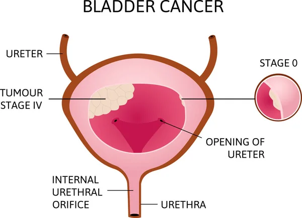 Cancer Urinblåsan Tumör Urinblåsan Med Inskriptioner Enkel Vektor Illustration Utveckling — Stock vektor