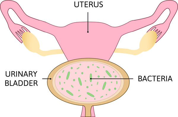 urinary tract infection. bladder infection, cystitis. it affects the upper urinary tract, infection and dreen bacteria. Human realistic uterus. Anatomy illustration.