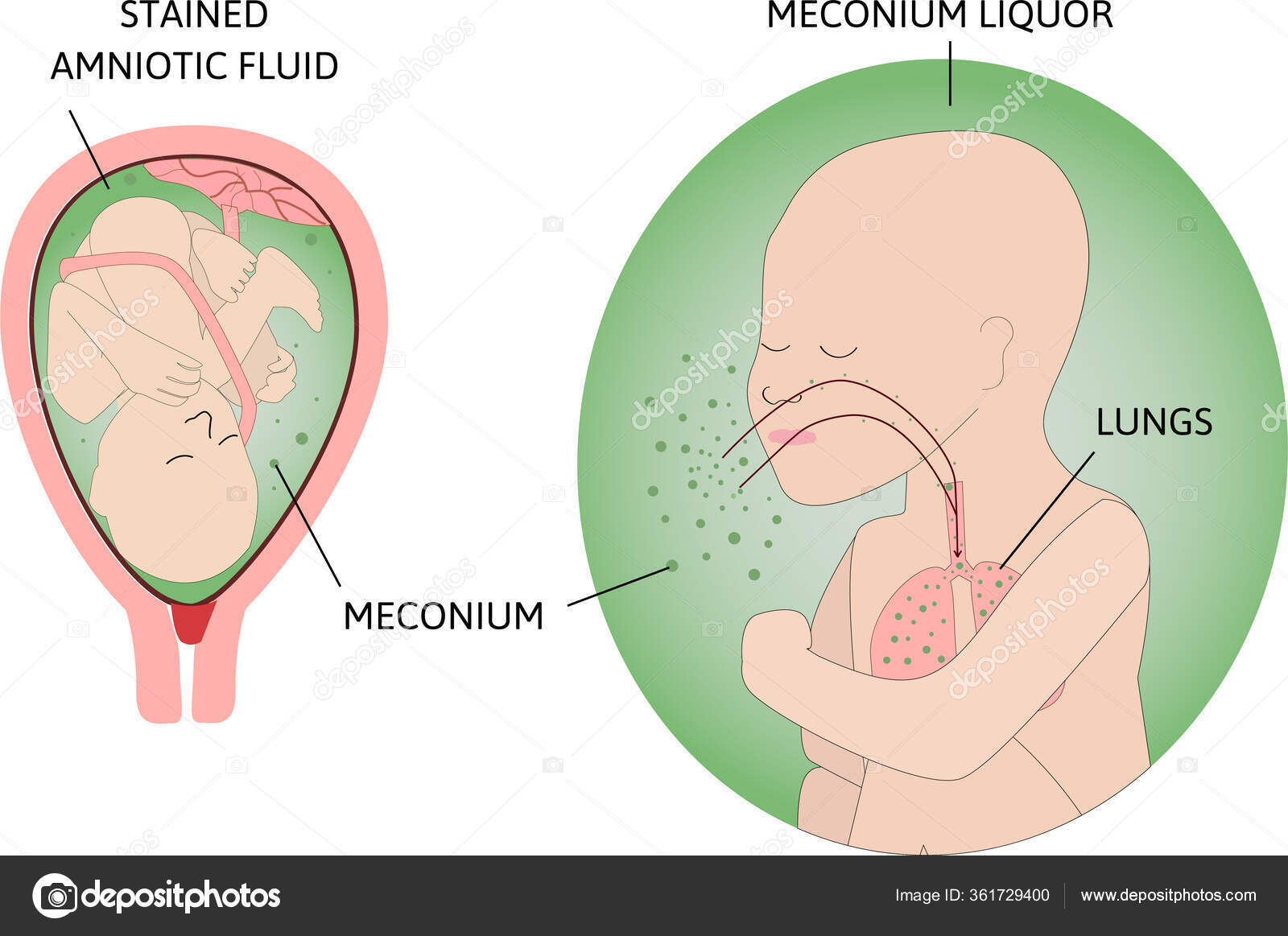 green amniotic fluid green amniotic fluid