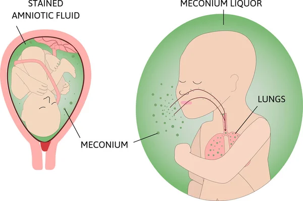 El proceso del síndrome de aspiración de Meconio MAS también conocido como aspiración neonatal de meconio. Feto en el útero. Mecinio a su alrededor. El niño respira con líquido amniótico verde . — Archivo Imágenes Vectoriales
