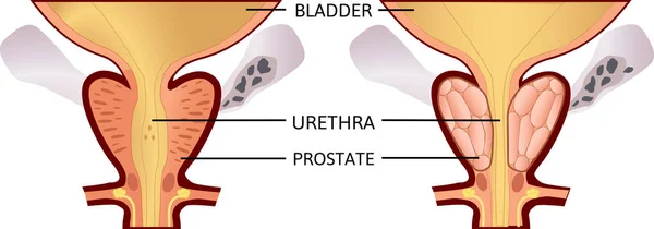 Benign prostatahyperplasi. prostatit. vektorillustration. Anatomi och hälsa. — Stock vektor