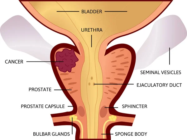 前列腺癌的第二阶段 肿瘤很大 位于前列腺内 — 图库矢量图片