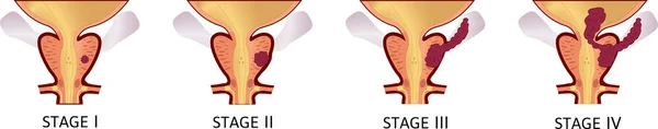 Stádia rakoviny prostaty od I do IV. Nádor roste a proniká do sousedních orgánů a tkání. Z malého nádoru do postiženého močového měchýře. — Stockový vektor