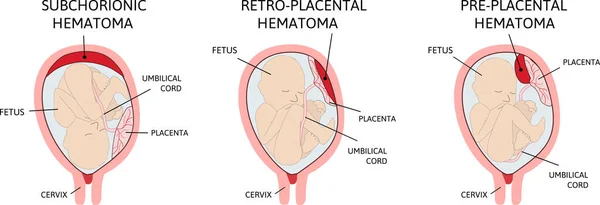 Placentahematom. blodproppar som uppstår från moderkakan. — Stock vektor