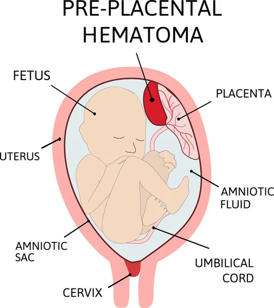 Hematoma placentário. coágulos sanguíneos que surgem da placenta . —  Vetores de Stock