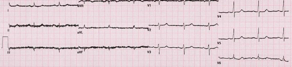 Eğri Elektrokardiyogram hattı — Stok fotoğraf