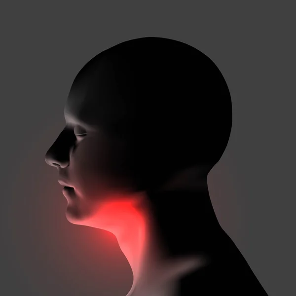 Laryngitis vectorillustratie. Irritatie van de keel van de menselijke. — Stockvector