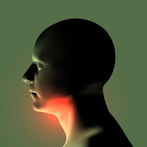 Laryngitis vectorillustratie. Irritatie van de keel van de menselijke. — Stockvector