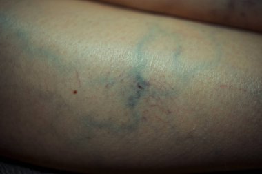 Telangiectasia 'nın damarların görsel teşhisi