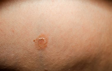 pink lichen of Gibert pityriasis rosea - fading of the rash element