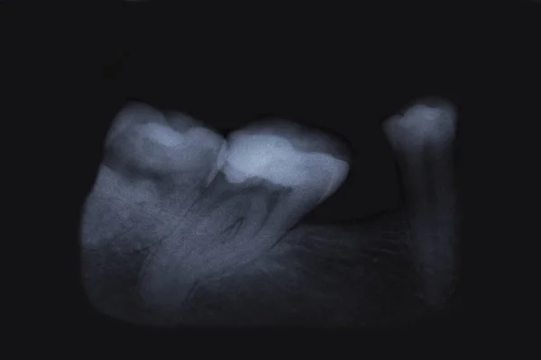 Raio Crânio Humano Dentes — Fotografia de Stock