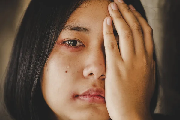 Sluiten Van Een Huilend Tienermeisje Met Gekneusde Huid Zwarte Ogen — Stockfoto