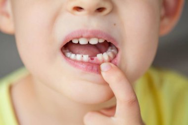 Close-up. The child dropped the first milk tooth. Happy little boy and milk tooth. clipart