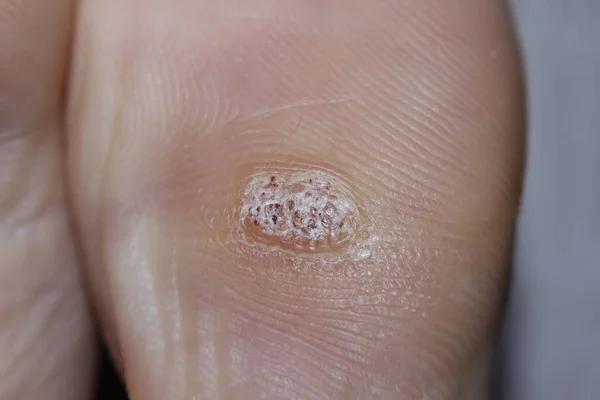 İnsan papillomavirüsünün neden olduğu ayak başparmağının altındaki bir plantar siğilinin HPV yakın çekim görüntüsü..