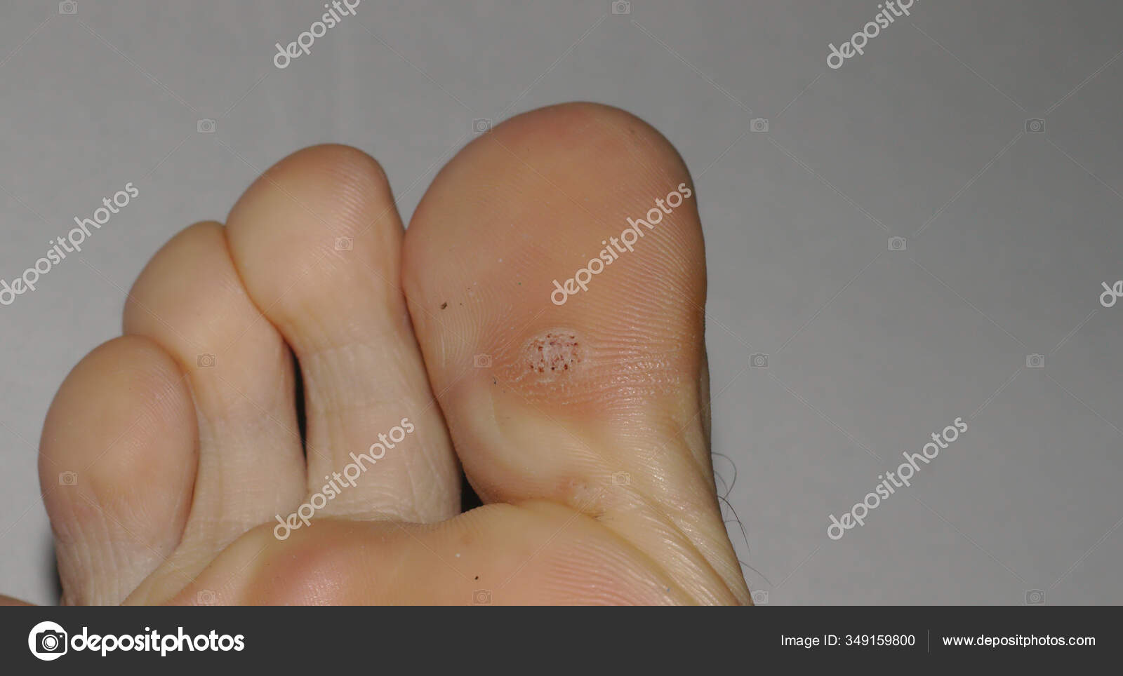 Close Shot Plantar Wart Bottom Big Toe Caused Human Papillomavirus