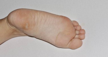 İnsan papillomavirüsü ya da HPV 'nin neden olduğu ayak topuğunun altındaki bir ayak siğilinin yakın çekim görüntüsü..