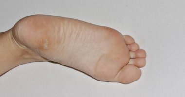 Close-up shot of a plantar wart on the bottom of a foot heel caused by the human papillomavirus, or HPV. clipart