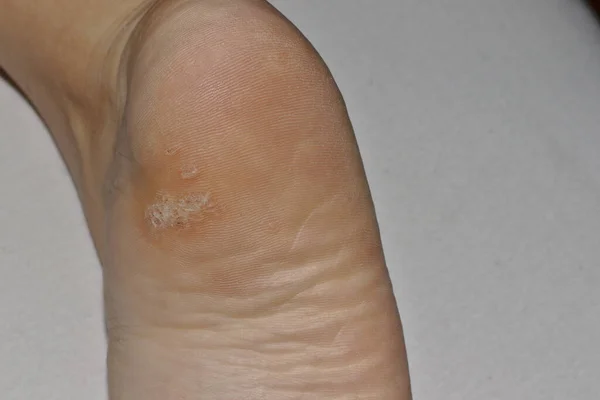 Close Shot Plantar Wart Bottom Foot Heel Caused Human Papillomavirus — Stock Photo, Image