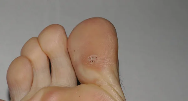 İnsan papillomavirüsü ya da HPV 'nin neden olduğu ayak başparmağının altındaki bir ayak ucu siğilinin yakın çekim görüntüsü..