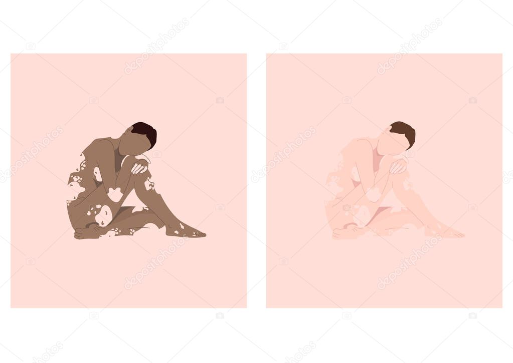 Vitiligo. Violation of the color of the skin. Vector illustration
