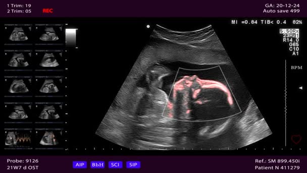 Exhibición del examen médico, ultrasonido durante embarazo — Vídeo de stock