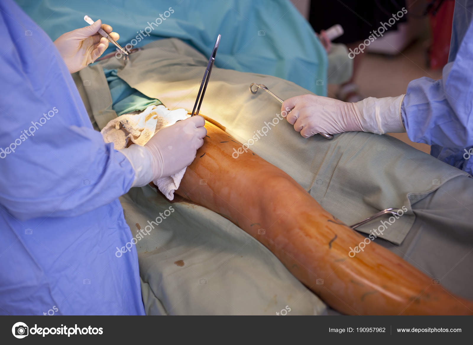 operation de varices operation de varices