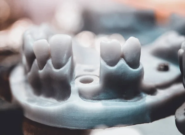 Diş ve implant taç abutment için delikleri daraltılabilir çene model 3d bir yazıcıda yazdırılan — Stok fotoğraf