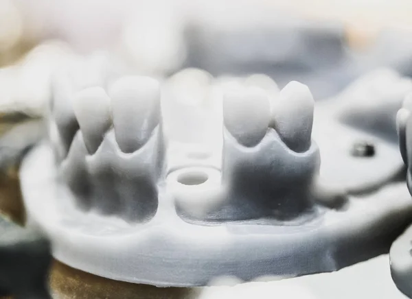 Collapsible jaw model with teeth and holes for the implant crown abutment printed on a 3d printer — Stock Photo, Image