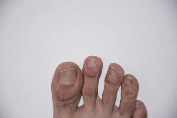 Нездоровые Мужчины Ноги Белом Фоне Вид Сверху Стоковое Изображение