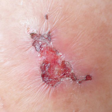 Bacak, diyabetik yaralar.