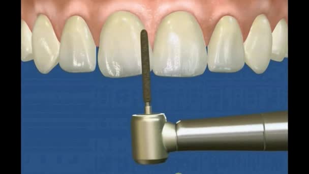 3D fogászati videó - Korona és híd Fogászati sebészet 62