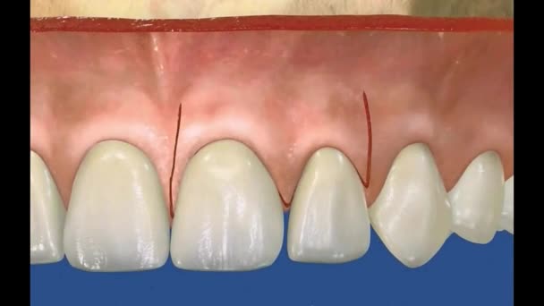 Zahnärztliches 3D-Video - Parodontal - Periodental 5