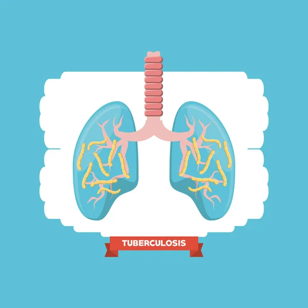 Concepto de Tubereculosis — Archivo Imágenes Vectoriales