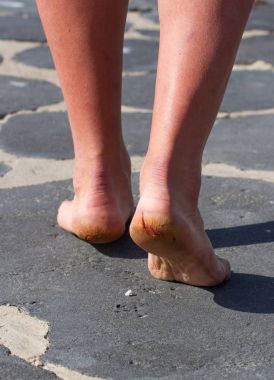 Makro fotoğraf kırık topuklu çifti. Erkek arkadan görünüm. Çatlak topuk üzerinde kapatın. Arkadan Görünüm