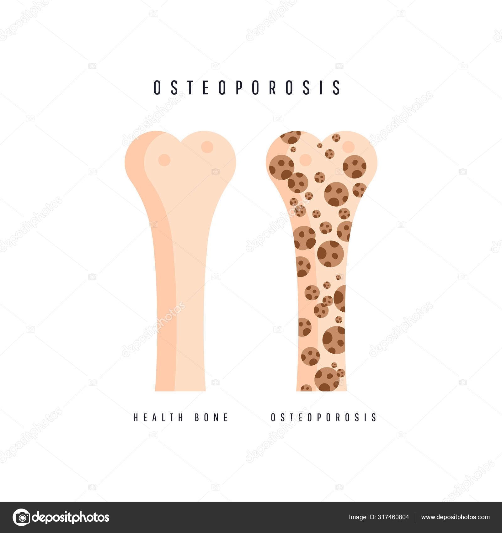 Illustration of osteoporosis bone and healthy bone. Stock Vector Image by ©irinashatilova #317460804 Illustration of osteoporosis bone and healthy bone. Stock Vector Image by ©irinashatilova #317460804