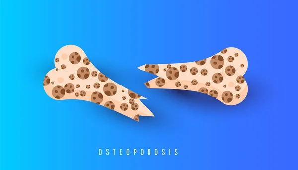 Osteoporose bot en gezond bot. — Stockvector