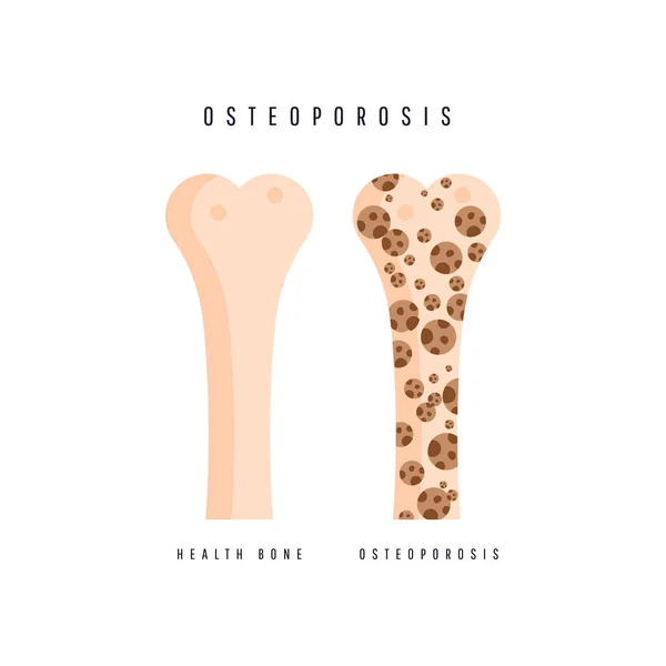 Illustratie van osteoporose bot en gezond bot. — Stockvector