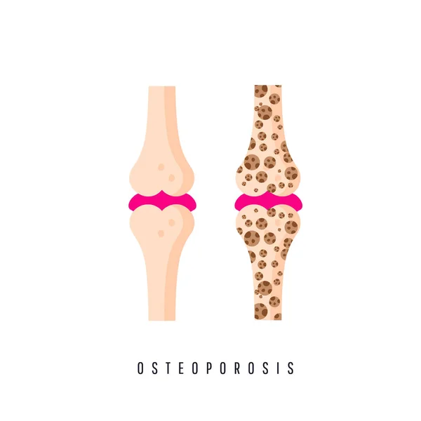 Dos huesos son normales y doloridos. Hueso de osteoporosis y hueso sano . — Vector de stock