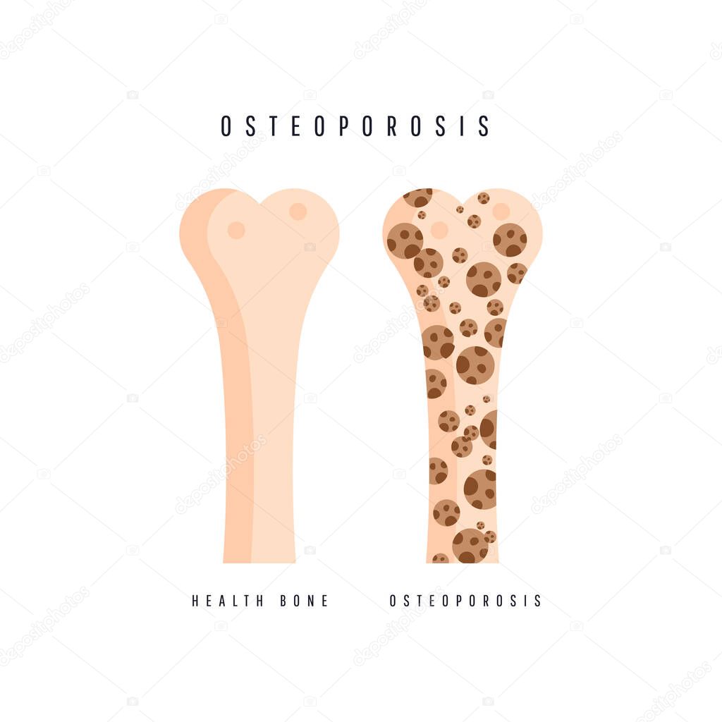Illustration of osteoporosis bone and healthy bone.