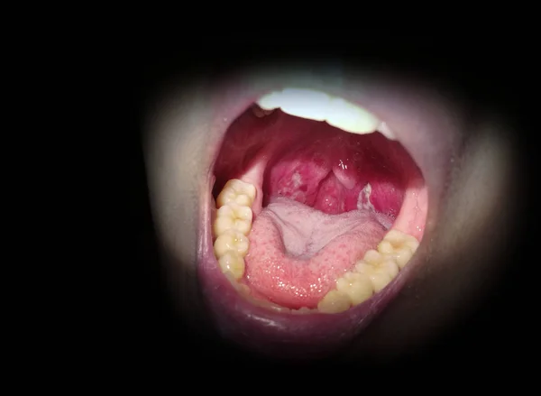 Tonsilistic accidenc met tandarts — Stockfoto