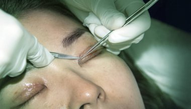 Güzellik ve tıp endüstrisinde göz kapağı ameliyatını kapat