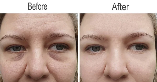 Caucasian girl face wrinkles after removal