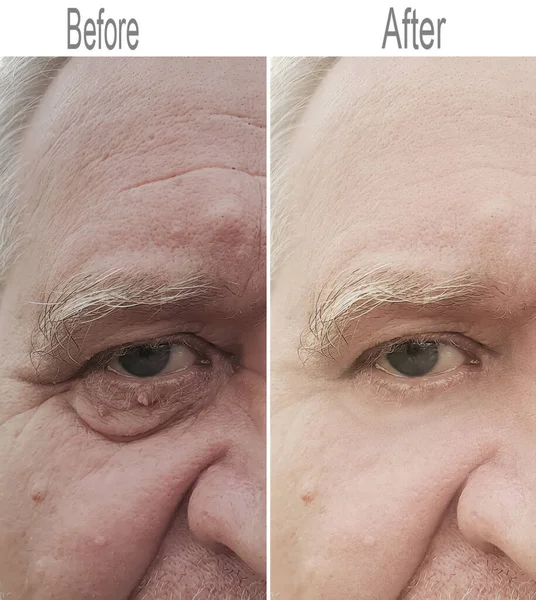Caucasian adult male face wrinkles after removal