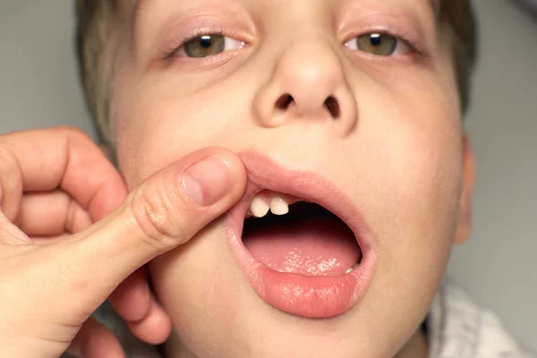 Ένα Εξάχρονο Παιδί Που Δείχνει Του Λείπουν Δόντια Έχασε Δύο — Φωτογραφία Αρχείου