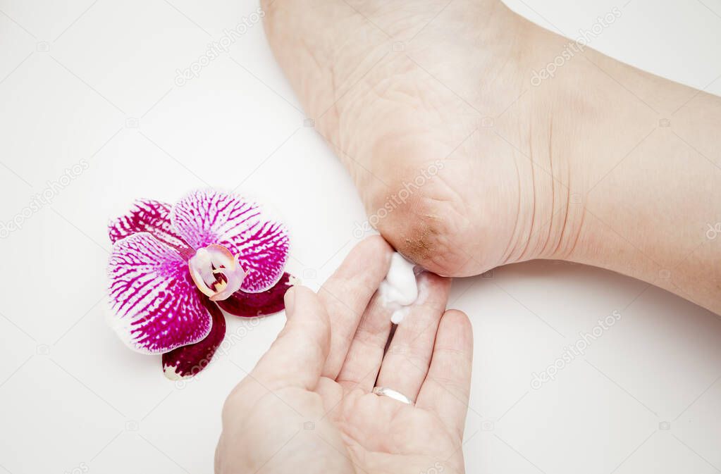 Hand apply white repairing lotion on ugly crackled heel, therapy concept.